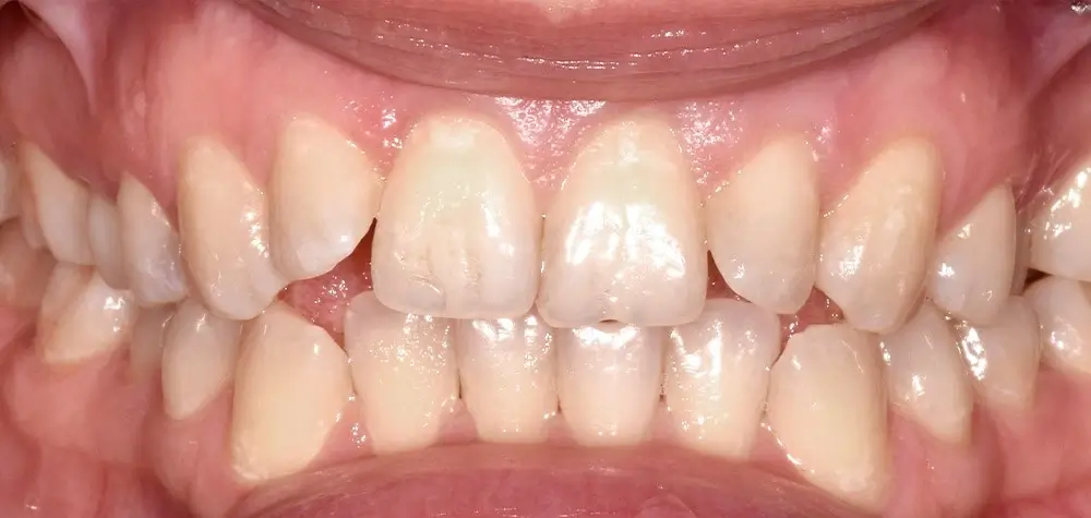 Глубокий прикус - Кейс 1 — фронтальный ракурс до лечения