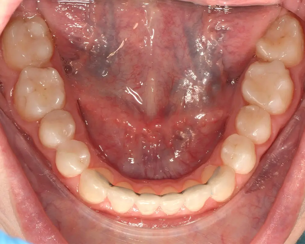 Глубокий прикус - Кейс 1 — нижняя челюсть после лечения