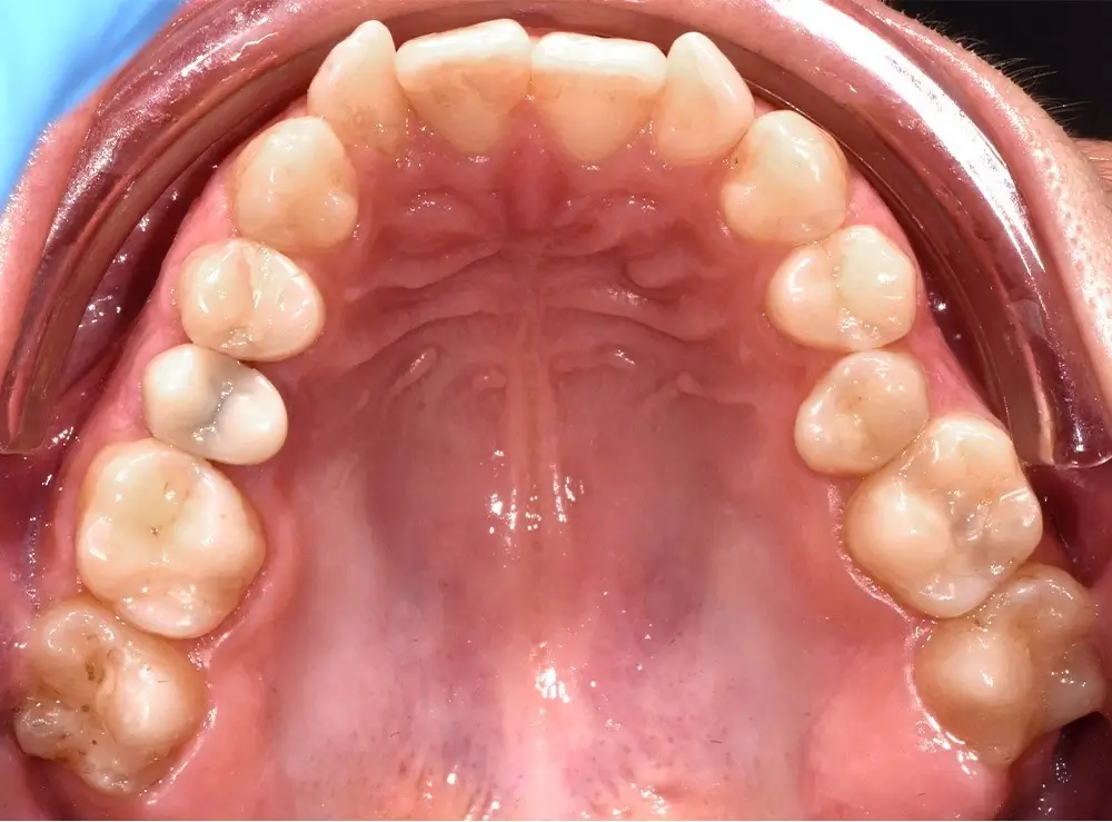 Глубокий прикус - Кейс 1 — верхняя челюсть до лечения
