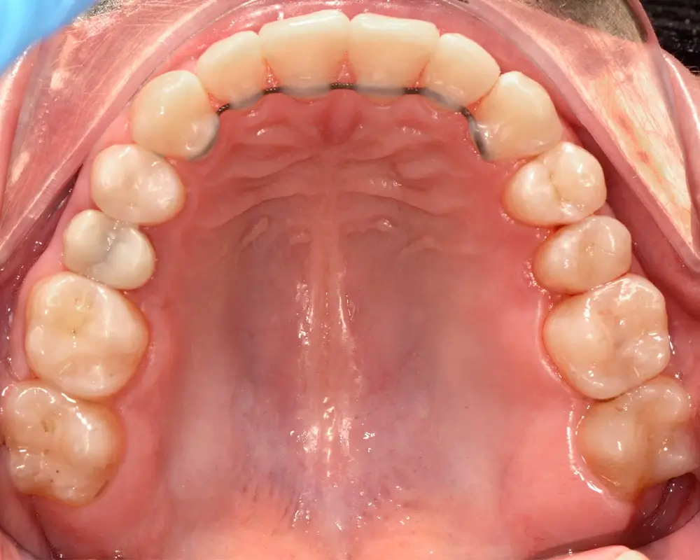 Глубокий прикус - Кейс 1 — верхняя челюсть после лечения