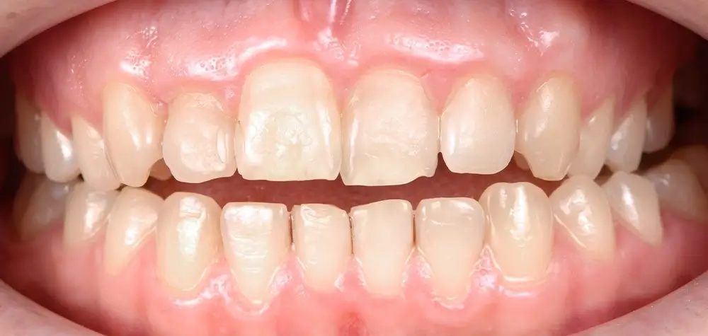 Глубокий прикус - Кейс 2 — фронтальный ракурс до лечения