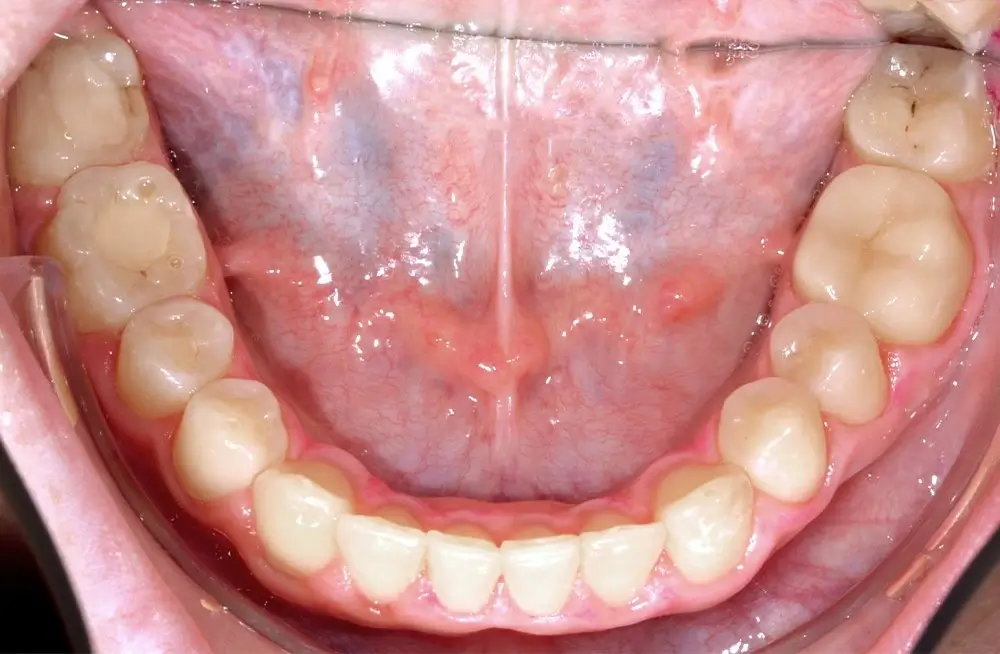 Глубокий прикус - Кейс 2 — нижняя челюсть после лечения
