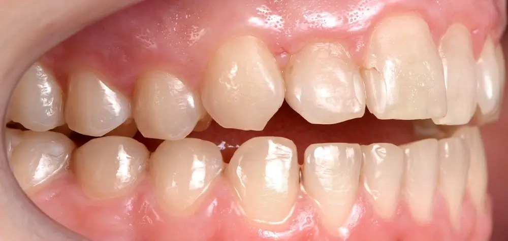 Глубокий прикус - Кейс 2 — боковой ракурс до лечения