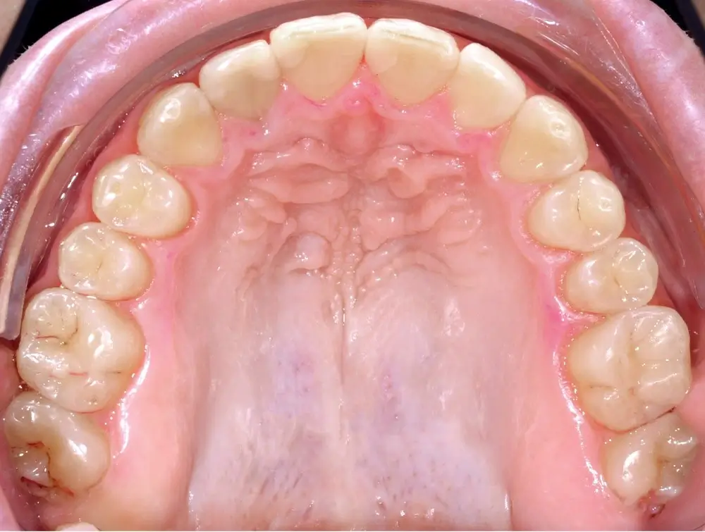 Глубокий прикус - Кейс 2 — верхняя челюсть после лечения