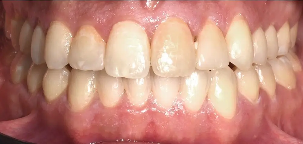 Глубокий прикус - Кейс 3 — фронтальный ракурс после лечения