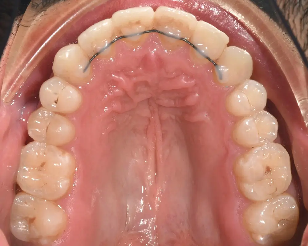 Глубокий прикус - Кейс 3 — верхняя челюсть после лечения