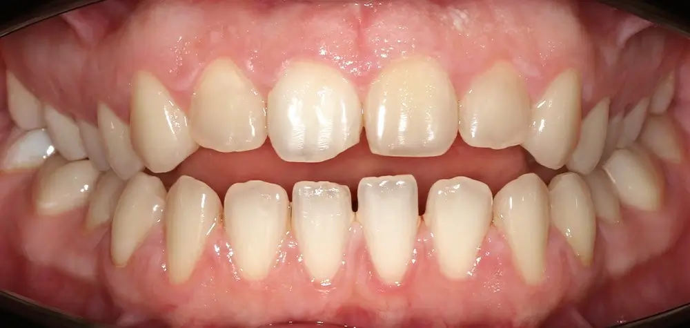 Глубокий прикус - Кейс 4 — фронтальный ракурс до лечения