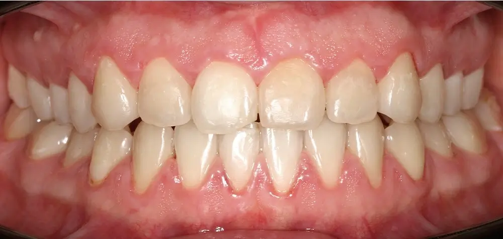 Глубокий прикус - Кейс 4 — фронтальный ракурс после лечения