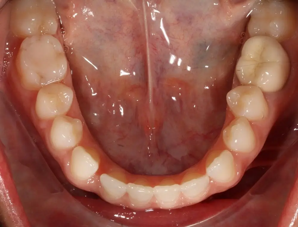 Глубокий прикус - Кейс 4 — нижняя челюсть до лечения