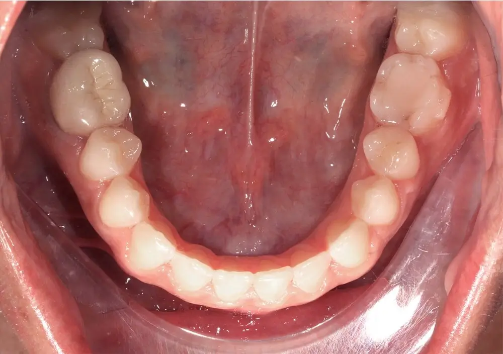 Глубокий прикус - Кейс 4 — нижняя челюсть после лечения
