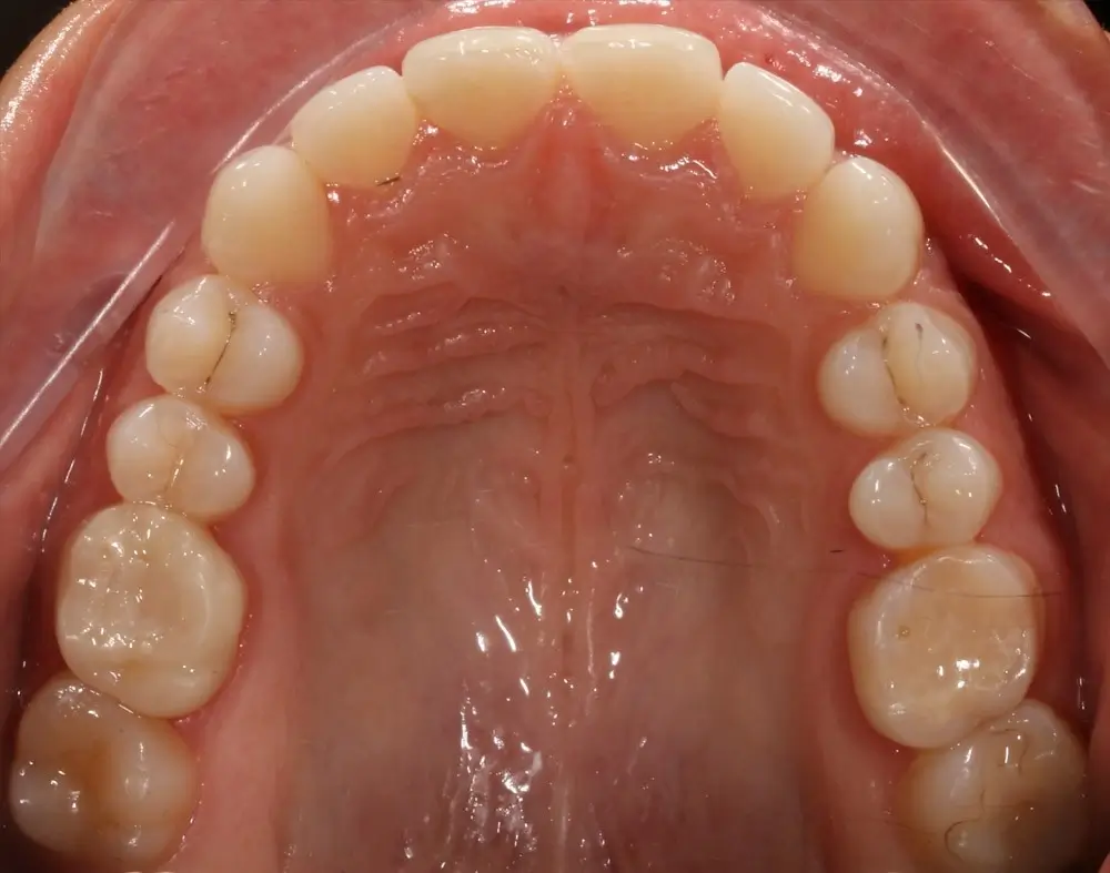 Глубокий прикус - Кейс 4 — верхняя челюсть до лечения