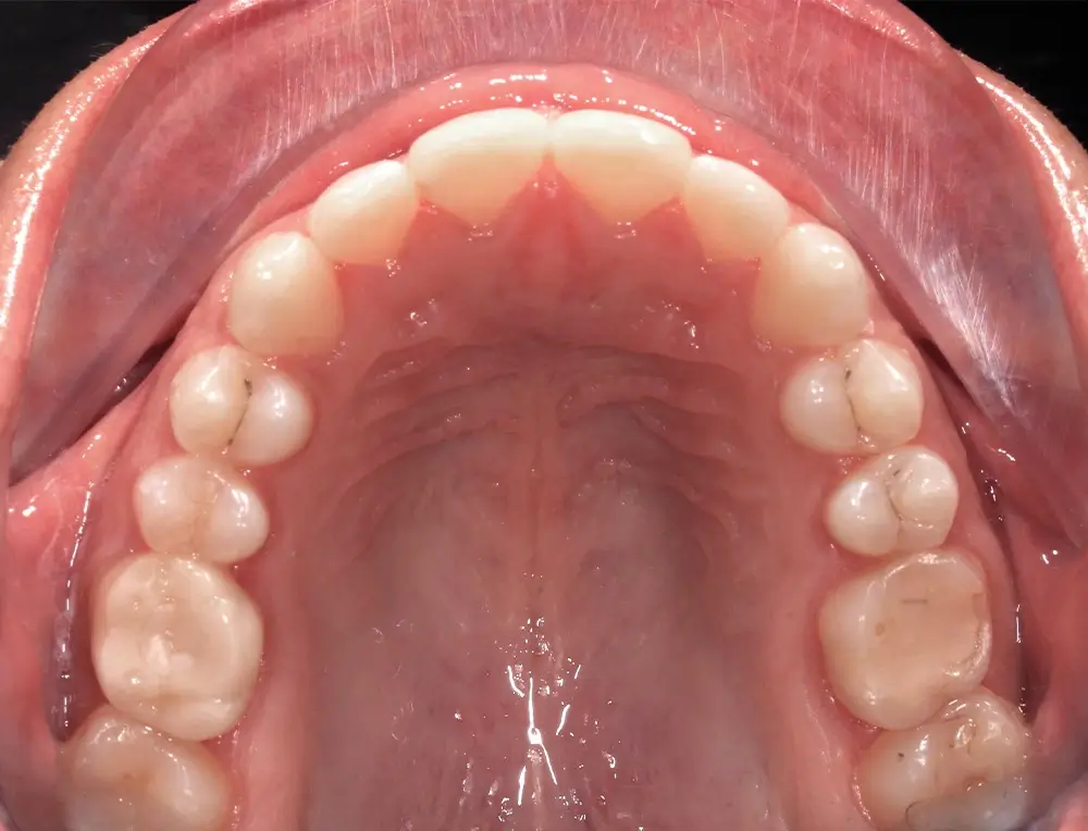 Глубокий прикус - Кейс 4 — верхняя челюсть после лечения
