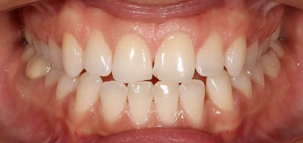Глубокий прикус - Кейс 5 — фронтальный ракурс до лечения