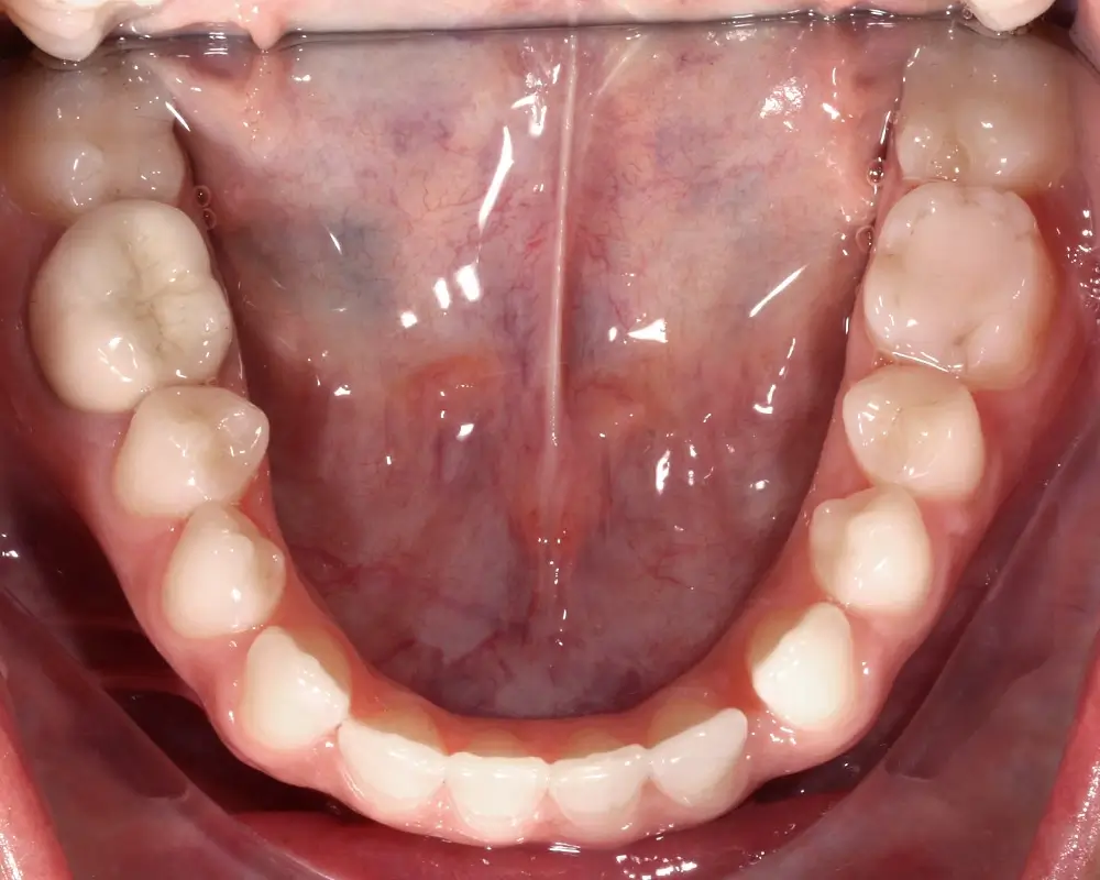 Глубокий прикус - Кейс 5 — нижняя челюсть до лечения