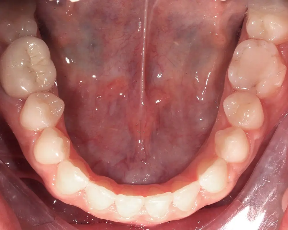 Глубокий прикус - Кейс 5 — нижняя челюсть после лечения