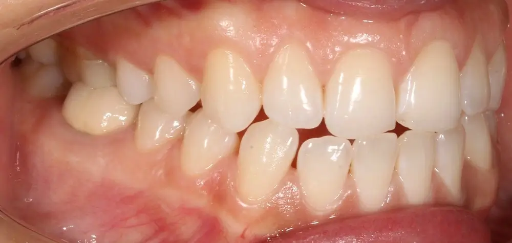 Глубокий прикус - Кейс 5 — боковой ракурс до лечения