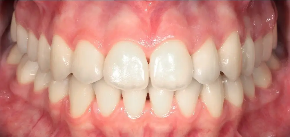Глубокий прикус - Кейс 6 — фронтальный ракурс после лечения