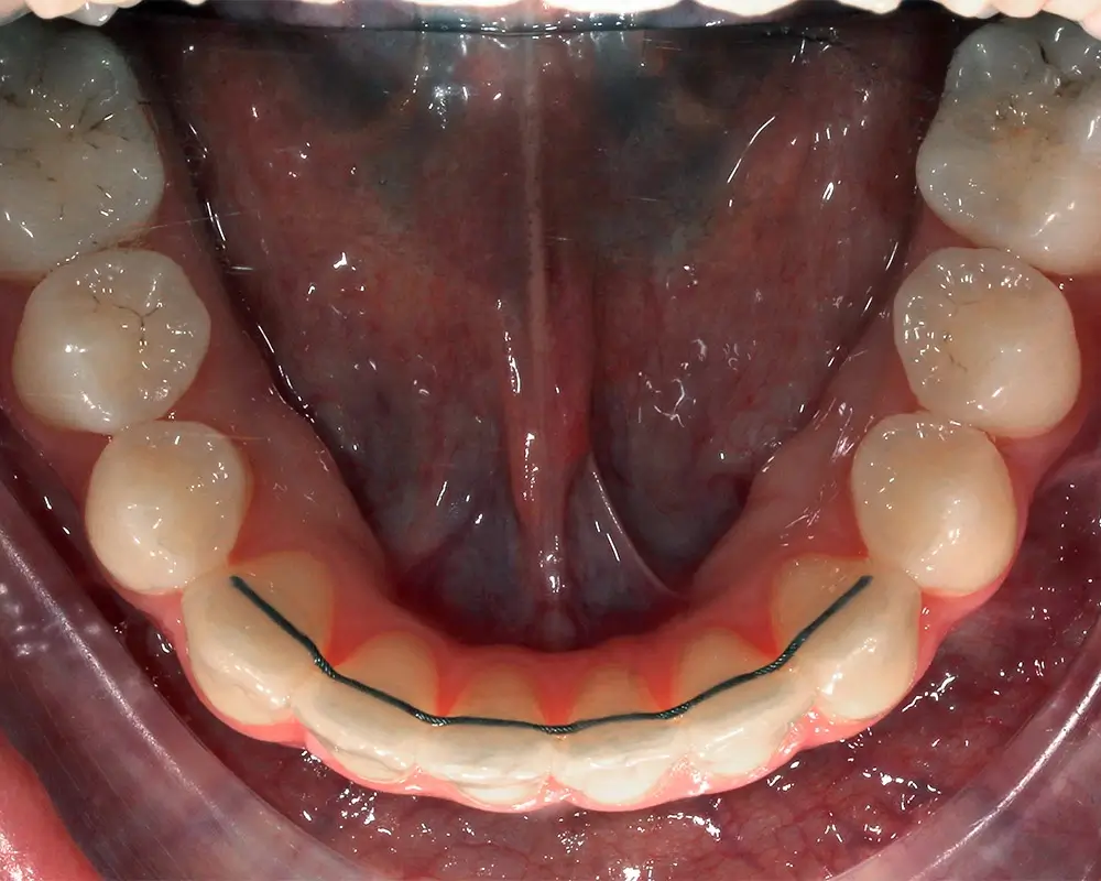Глубокий прикус - Кейс 6 — нижняя челюсть после лечения