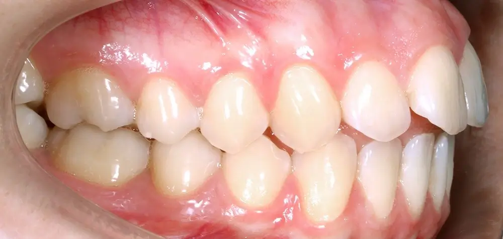 Глубокий прикус - Кейс 6 — боковой ракурс до лечения