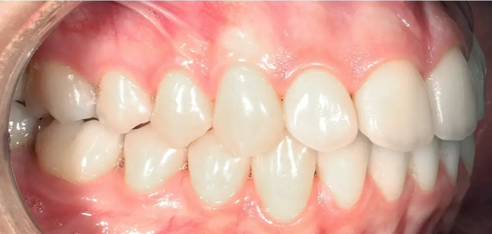 Глубокий прикус - Ке йс 6 — боковой ракурс после лечения