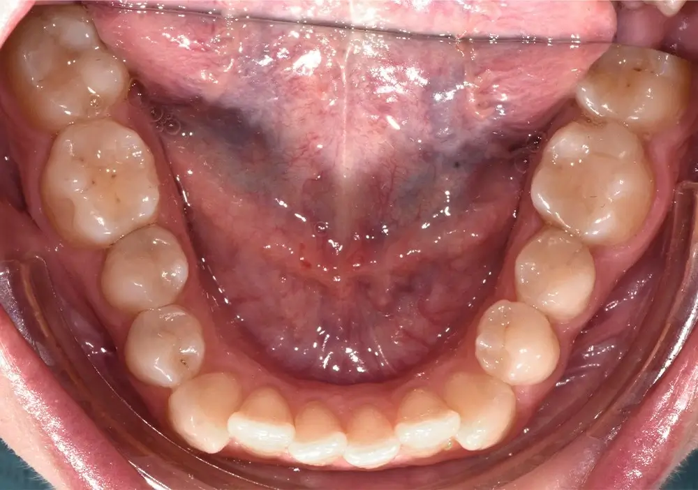 Открытый прикус - Кейс 1 — нижняя челюсть до лечения