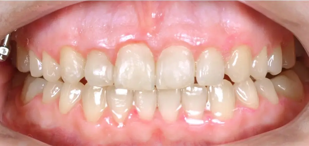 Открытый прикус - Кейс 2 — фронтальный ракурс после лечения