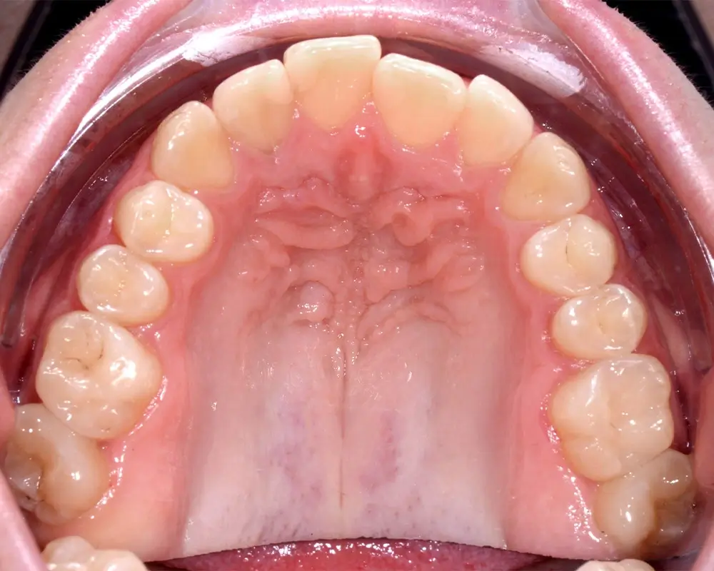 Открытый прикус - Кейс 2 — верхняя челюсть до лечения