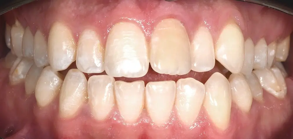 Открытый прикус - Кейс 3 — фронтальный ракурс до лечения