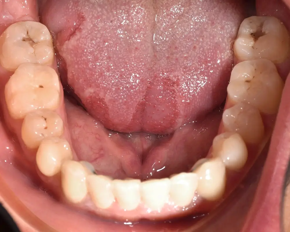 Открытый прикус - Кейс 3 — нижняя челюсть после лечения