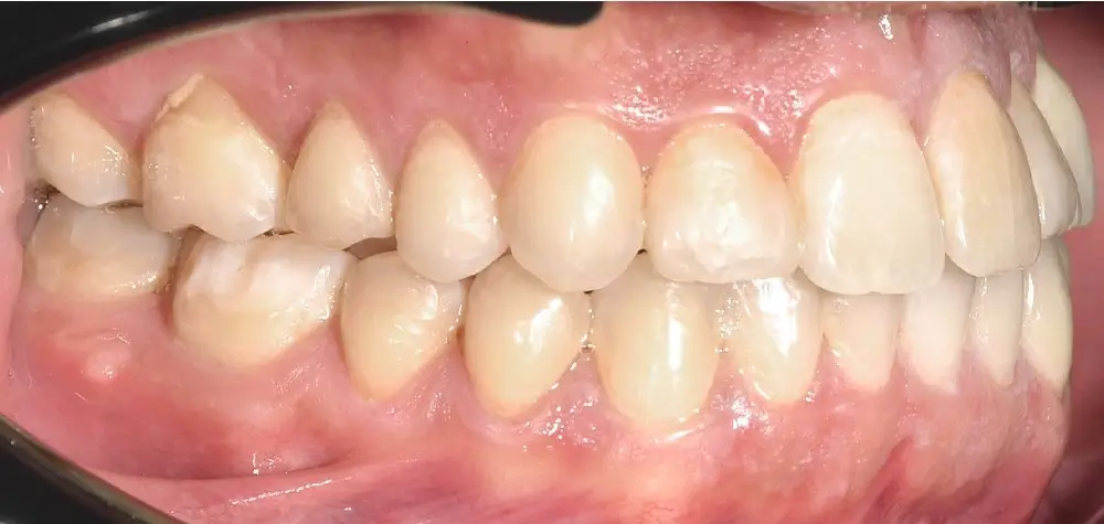 Открытый прикус - Кейс 3 — боковой ракурс после лечения