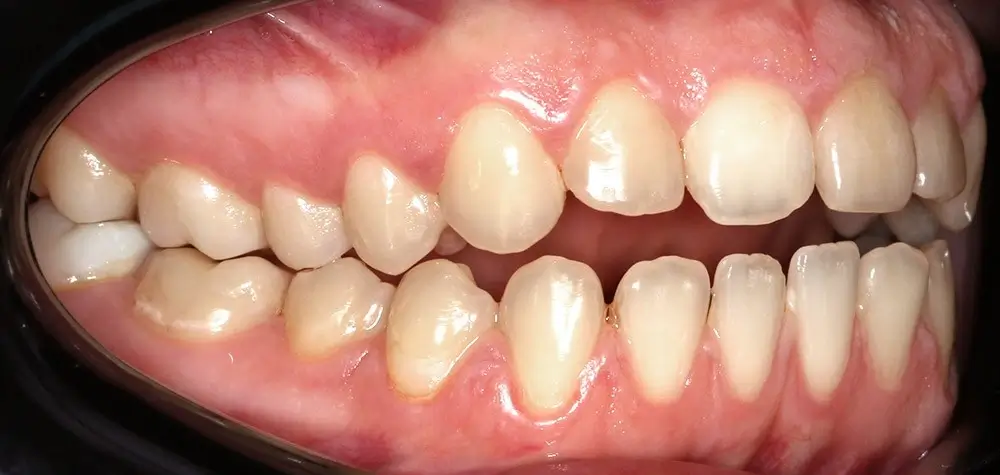 Открытый прикус - Кейс 4 — боковой ракурс до лечения