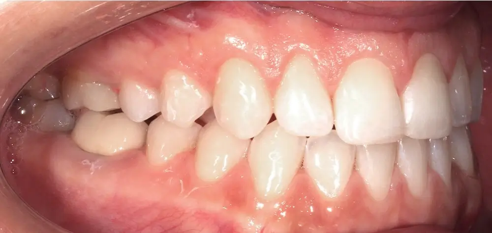 Открытый прикус - Кейс 5 — боковой ракурс после лечения
