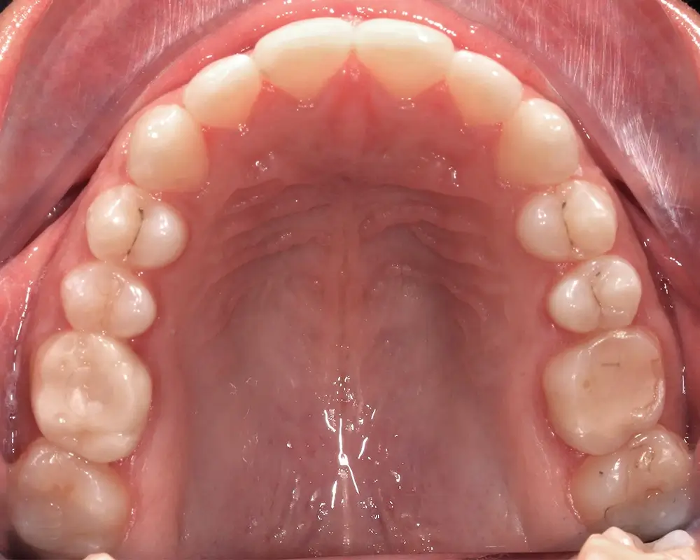 Открытый прикус - Кейс 5 — верхняя челюсть после лечения