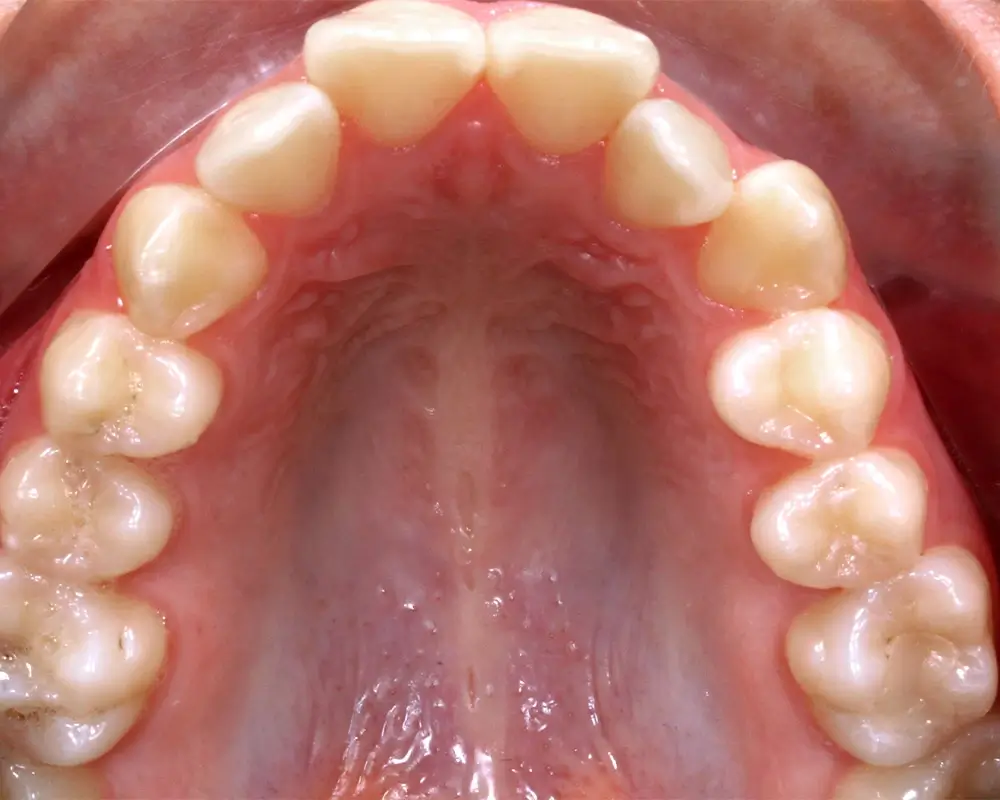Открытый прикус - Кейс 6 — верхняя челюсть до лечения
